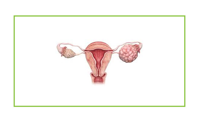 ovarian Cancer