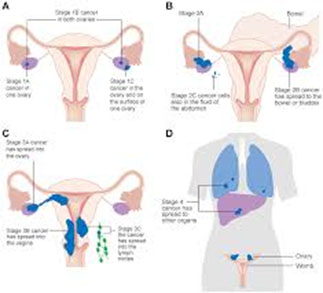 ovarian Cancer