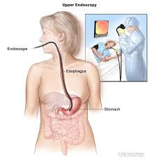 Stomach Cancer