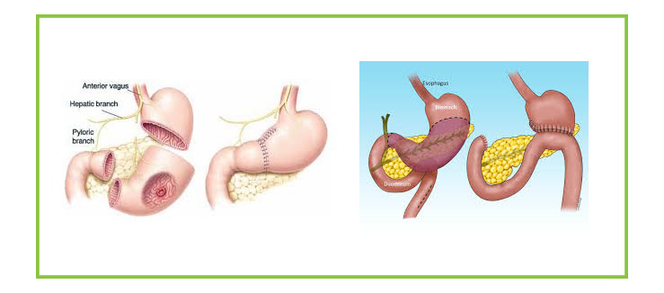 Stomach Cancer